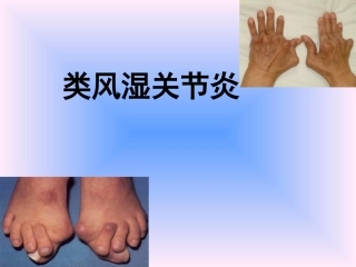 中西结合7年制教材(大量图片)类风湿性关节炎