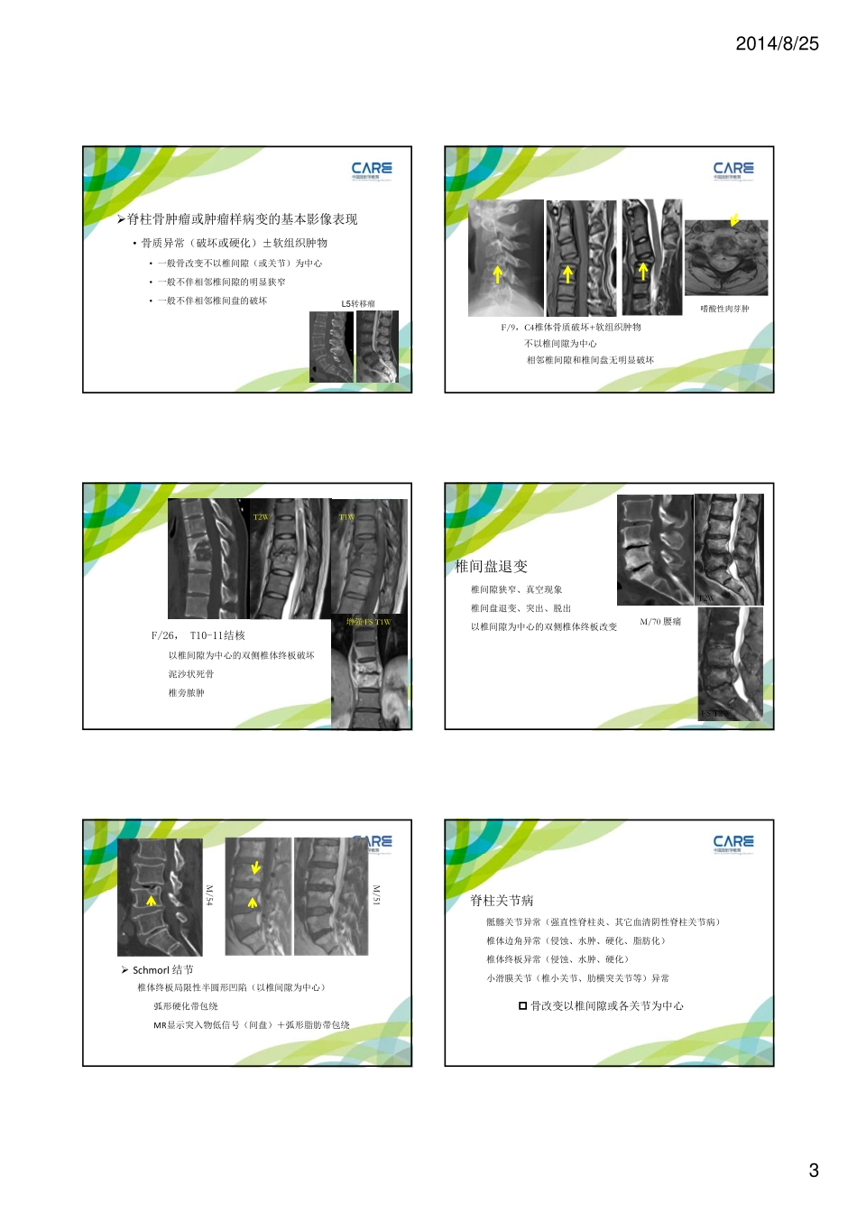 脊柱骨肿瘤的影像 ---郑卓肇_第3页