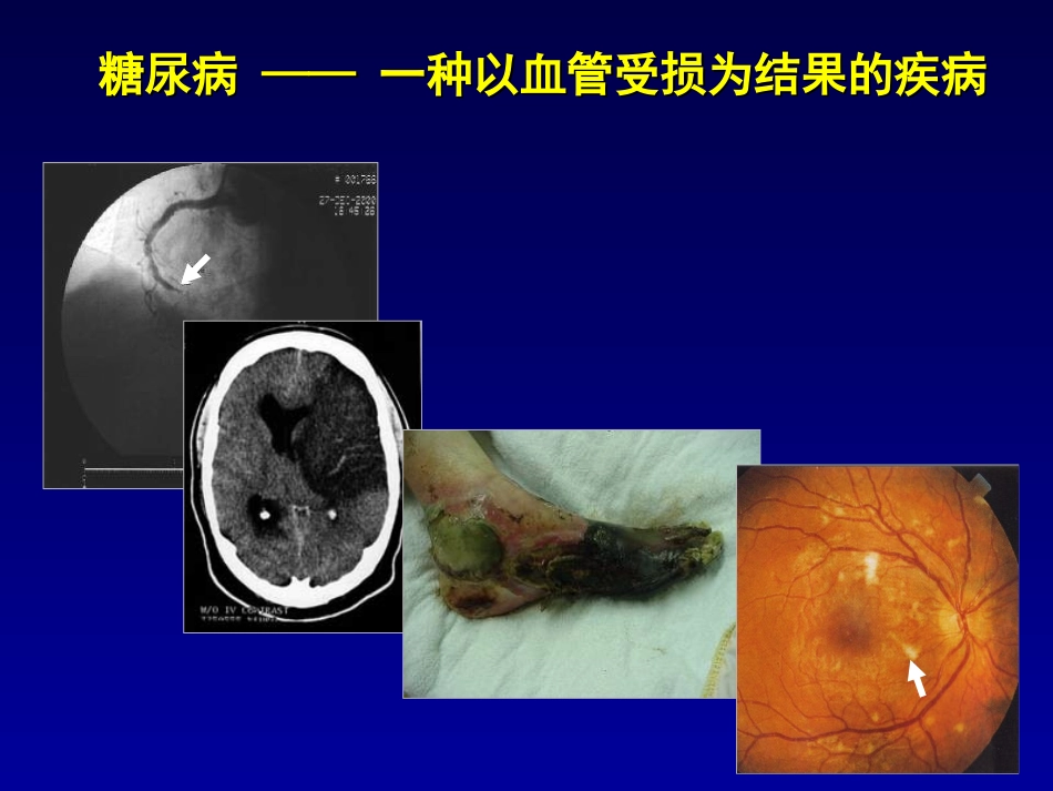 糖尿病大血管并发症_第2页