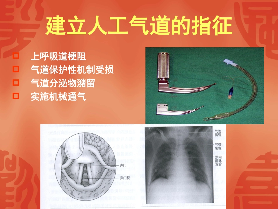 人工气道的建立与_第3页