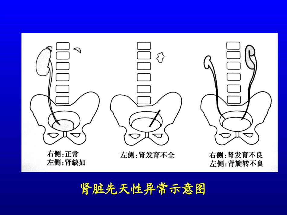 泌尿2先天异常_第3页