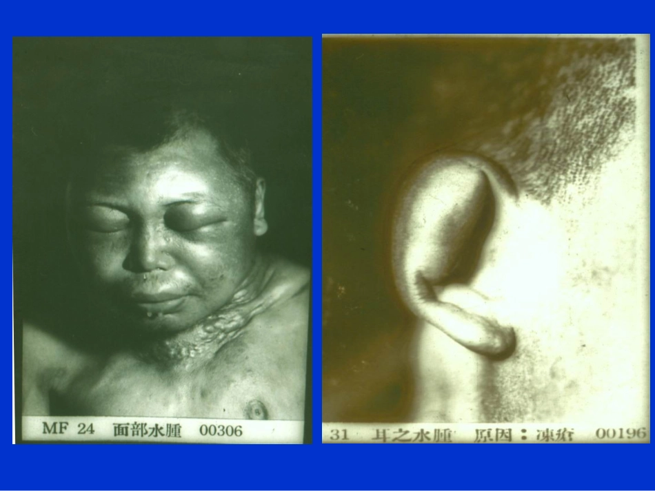 水肿和泌尿系统2_第2页