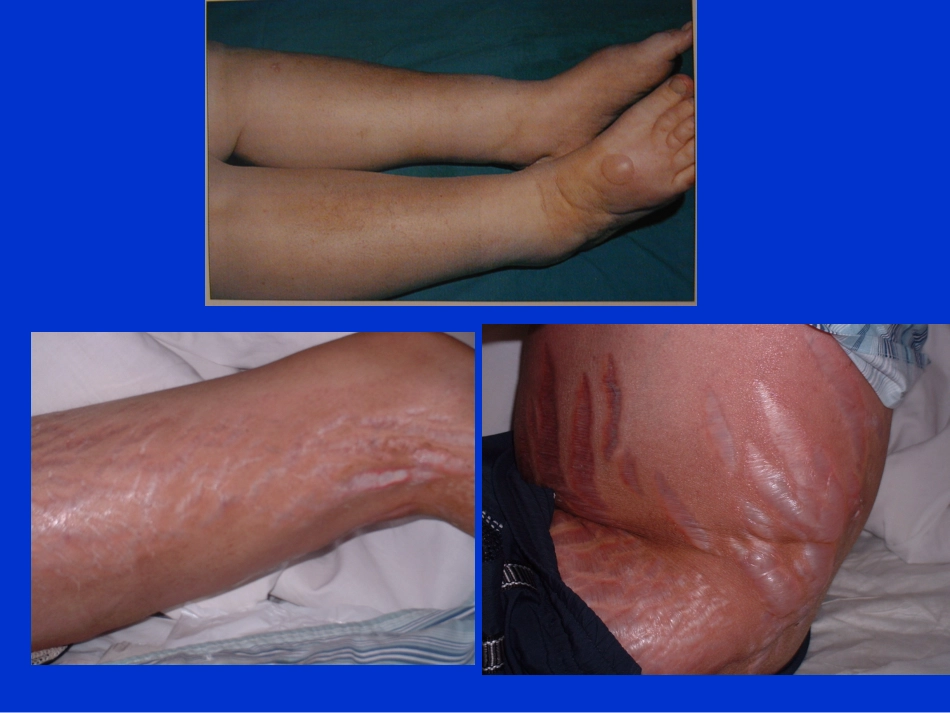 水肿和泌尿系统2_第3页