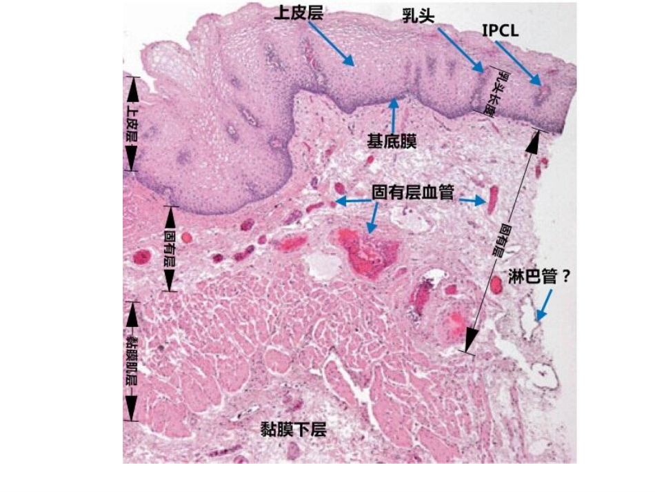 早期食管病变串讲0926_第2页