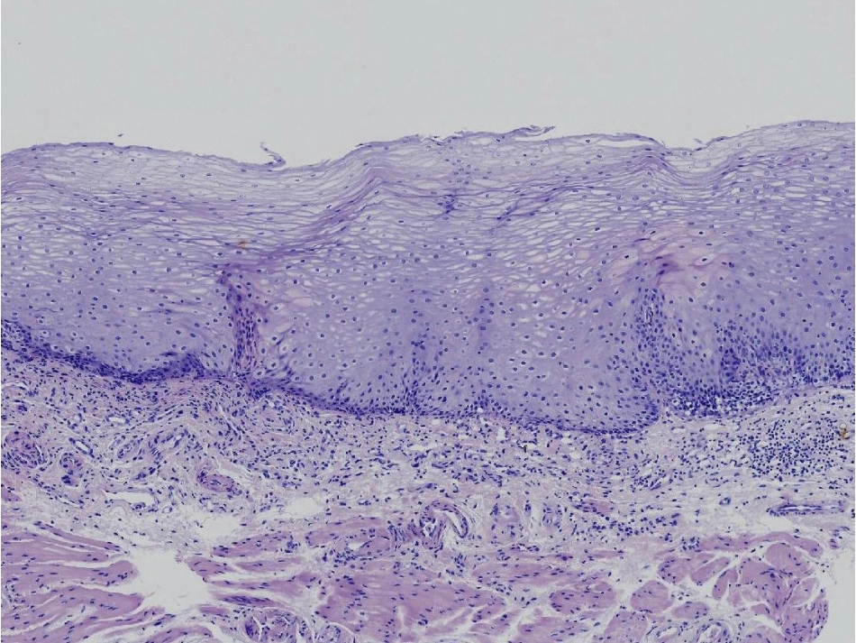 早期食管病变串讲0926_第3页