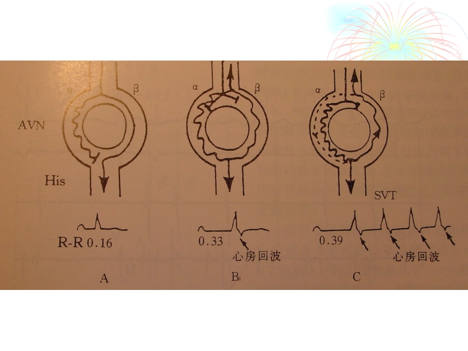 AVNRT-讲课_第3页