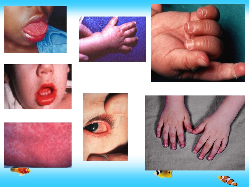 川崎病(田晓瑜)_第3页