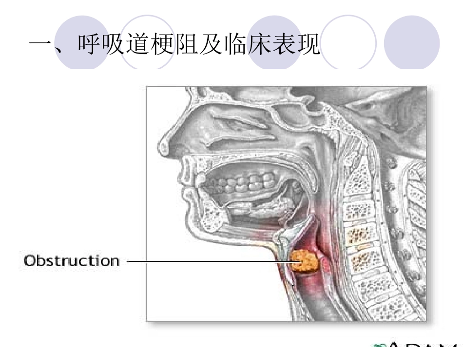 儿童气道梗塞急救法_第3页
