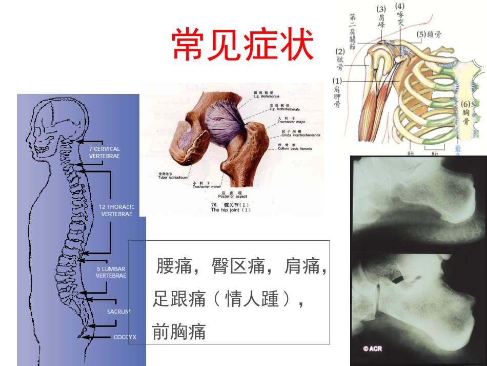 AS髋关节受累的思考_第3页