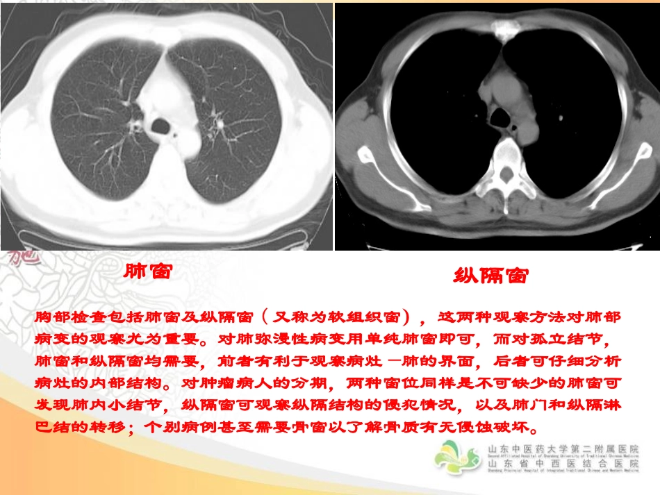 胸部影像学--CT篇_第2页