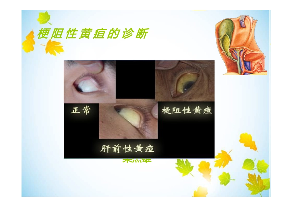 梗阻性黄疸的鉴别诊断_第1页