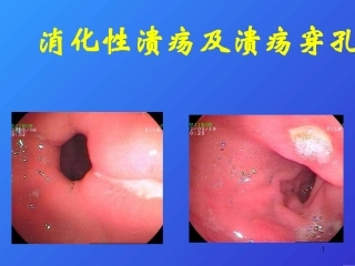 消化性溃疡08905