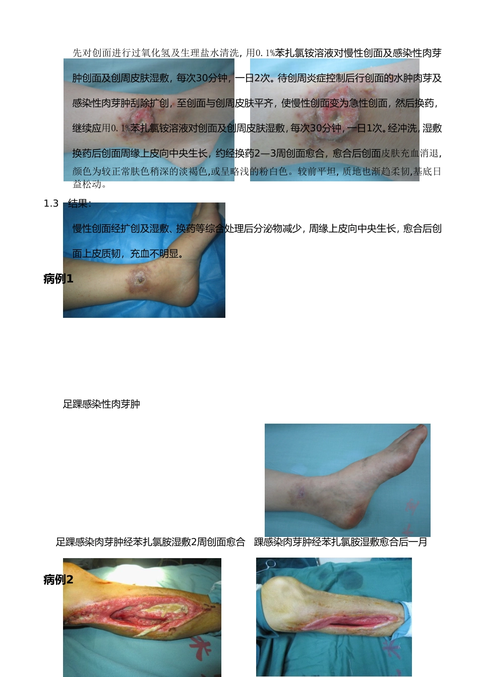 苯扎氯铵溶液在慢性创面及感染肉芽肿的临床应用及观察_第2页