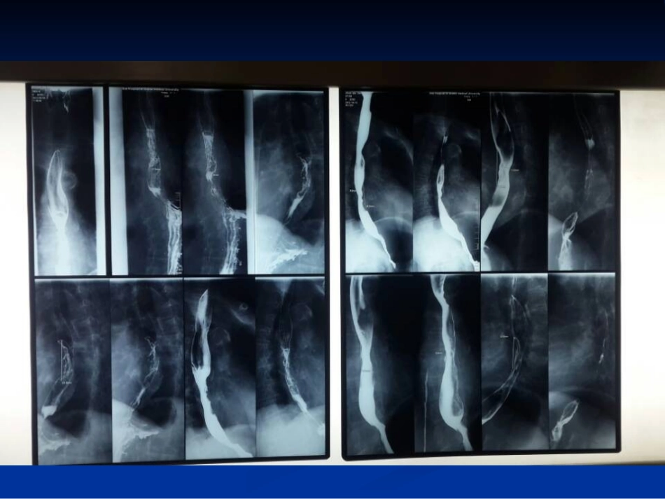 食管癌的新分期-JG_第2页