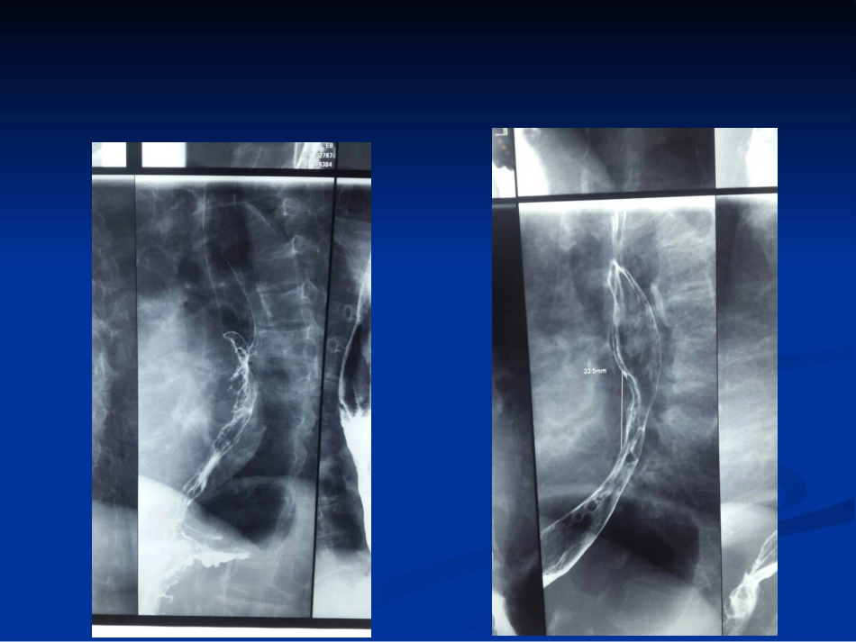 食管癌的新分期-JG_第3页