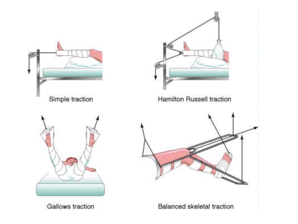 牵引、石膏护理_第3页