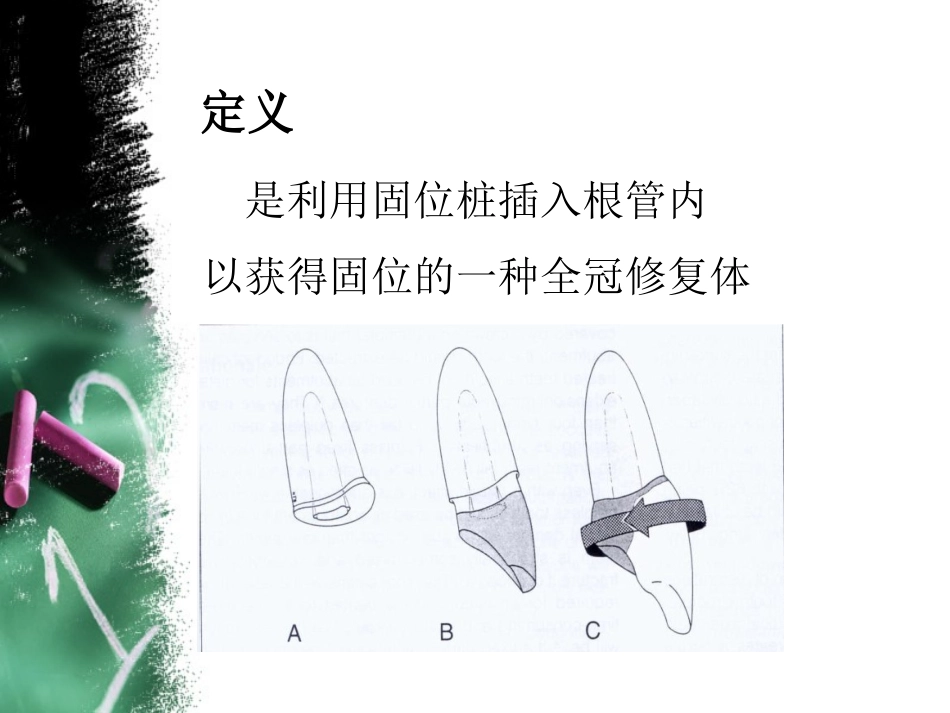 桩冠和桩核冠(免费)_第2页