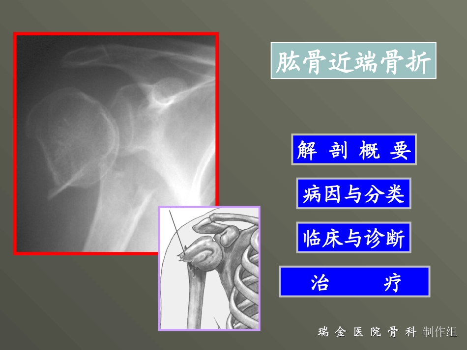 肱骨外科颈骨折_第1页