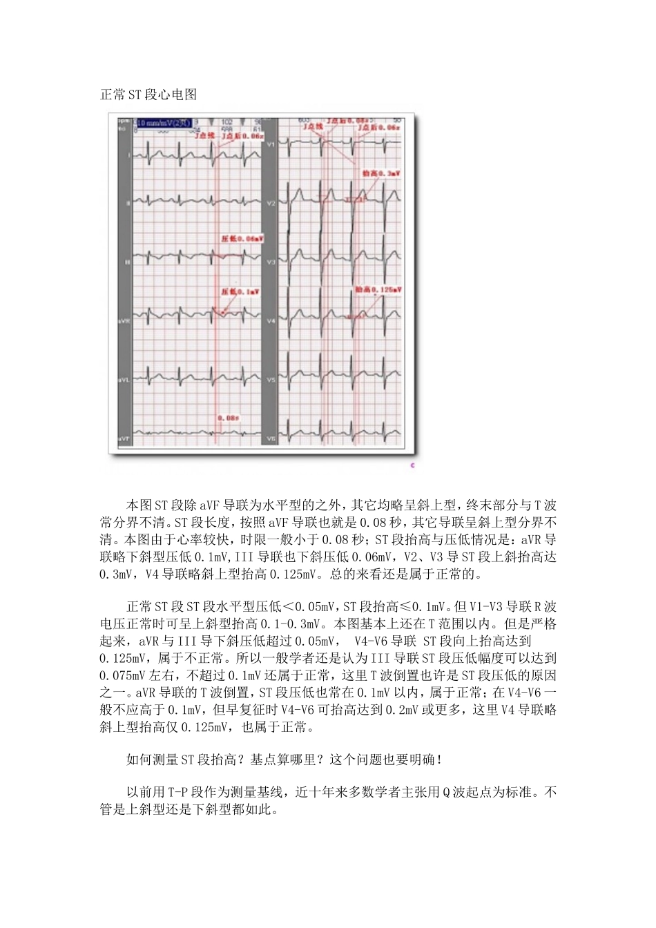 第十讲ST段分析_第2页