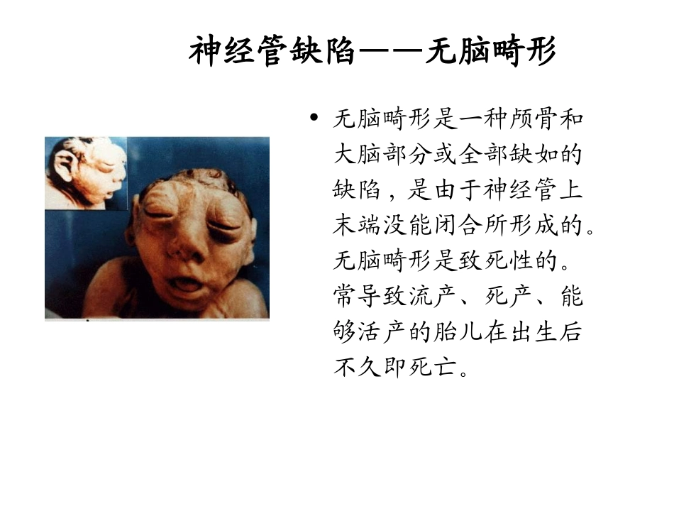 髓脊膜膨出少见,通常引起更为严重的残疾,需要手术修复。_第2页