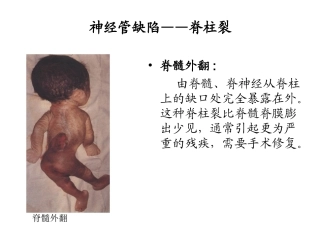 髓脊膜膨出少见,通常引起更为严重的残疾,需要手术修复。