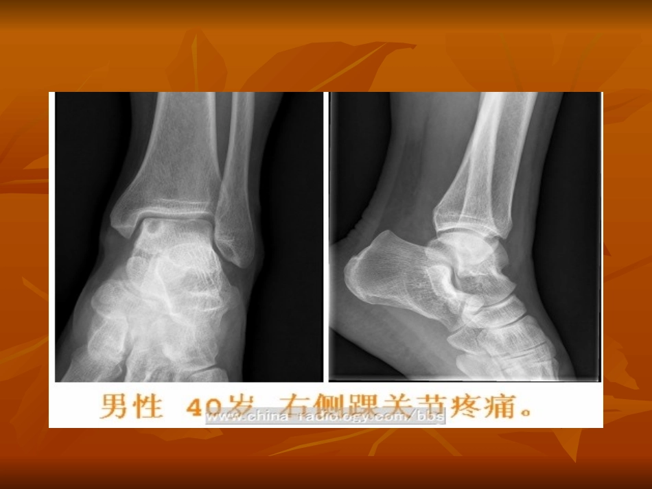 骨内腱鞘囊肿影像表现_第1页