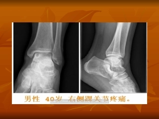 骨内腱鞘囊肿影像表现