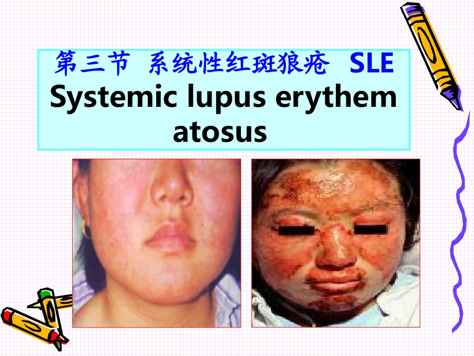 风湿性疾病护理_第2页