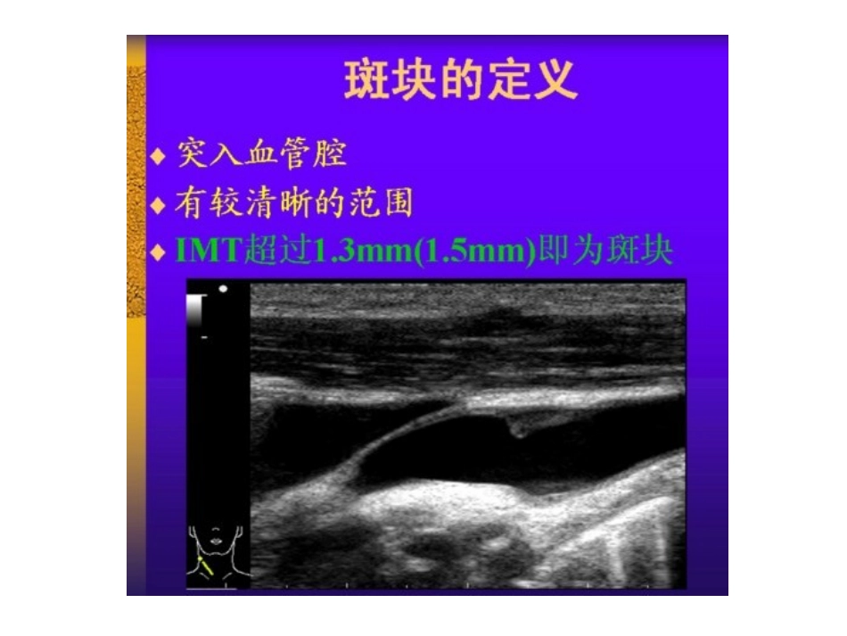 颈动脉血管超声诊断nt 演示文稿_第3页