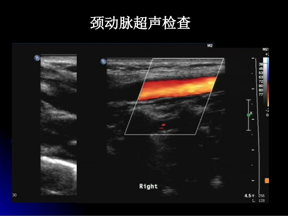 颈动脉、椎动脉超声检查范春芝2011_第3页