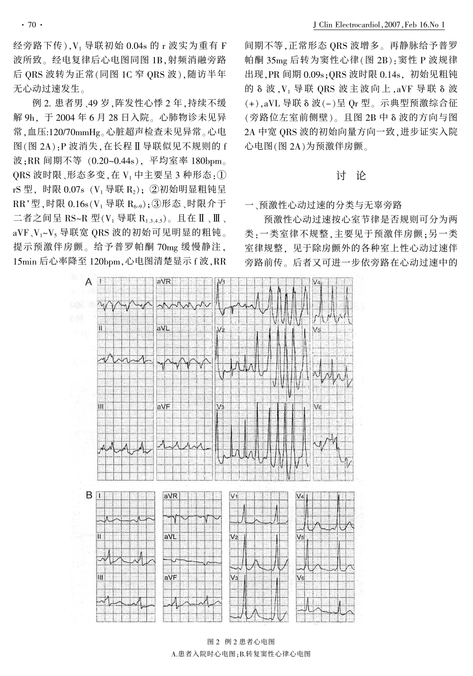 预激性心动过速心电图精读_第2页