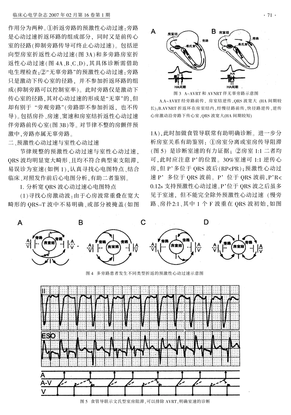 预激性心动过速心电图精读_第3页