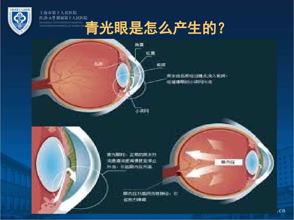 青光眼的药物治疗_第3页