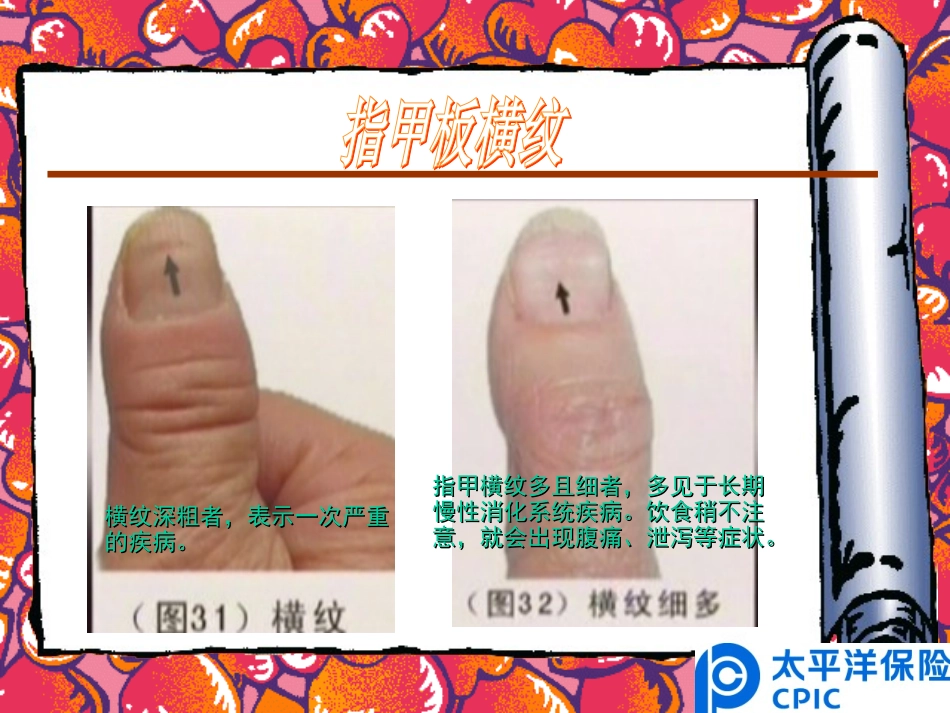 通过指甲检视健康_第3页