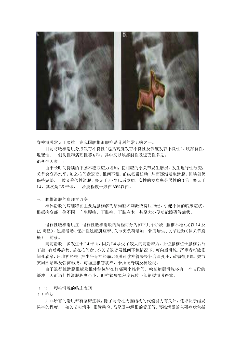 退行性腰椎滑脱症诊断_第3页