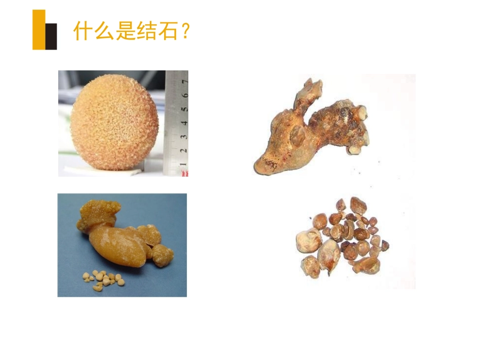 输尿管镜钬激光碎石宣教_第2页