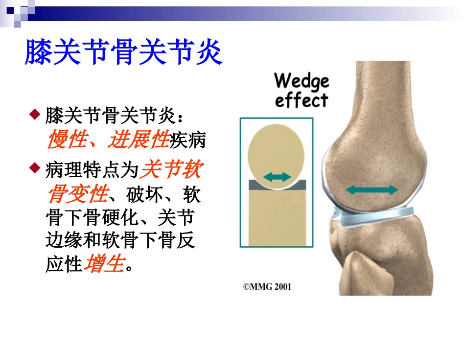 膝骨关节炎的防治_第2页
