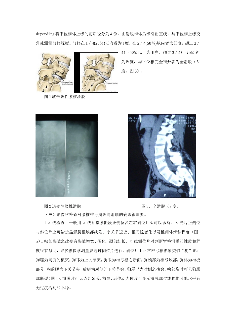 腰椎间盘突出症与腰椎滑脱鉴别_第2页
