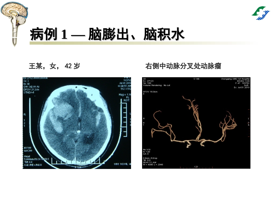 腰大池穿刺置管引流术_第2页