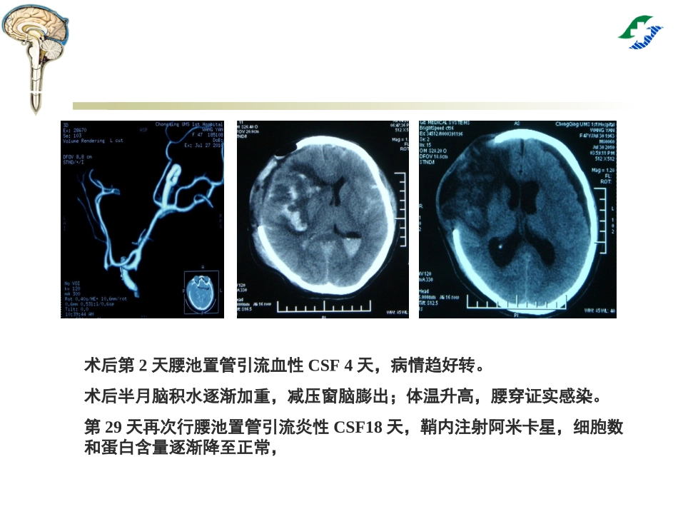 腰大池穿刺置管引流术_第3页