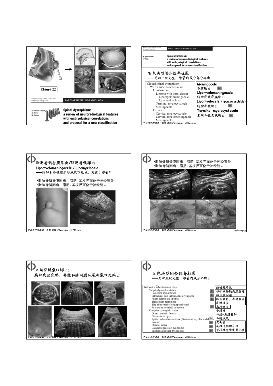 脊柱裂谢红宁 简单讲义_第2页