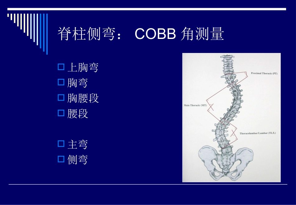 脊柱侧弯基础知识_第3页