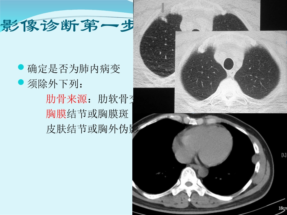胸部CT肺内孤立性结节_第3页