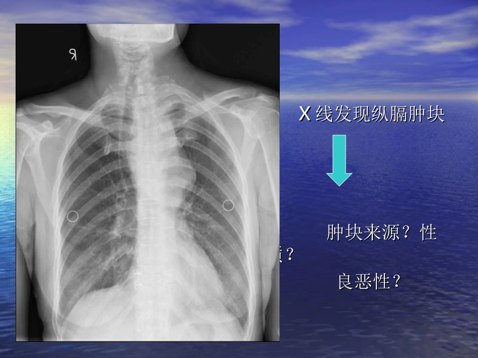 胸内甲状腺肿_第2页