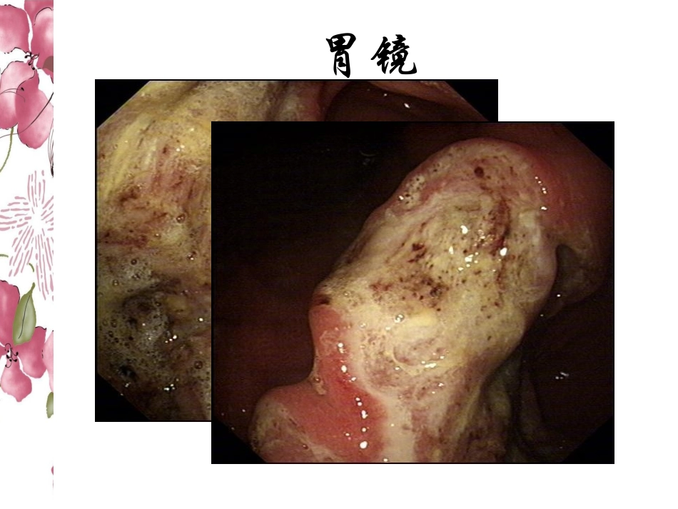 胃淋巴瘤-影像学简介_第3页