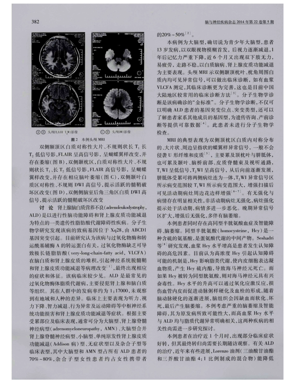 肾上腺脑白质营养不良一例_第2页