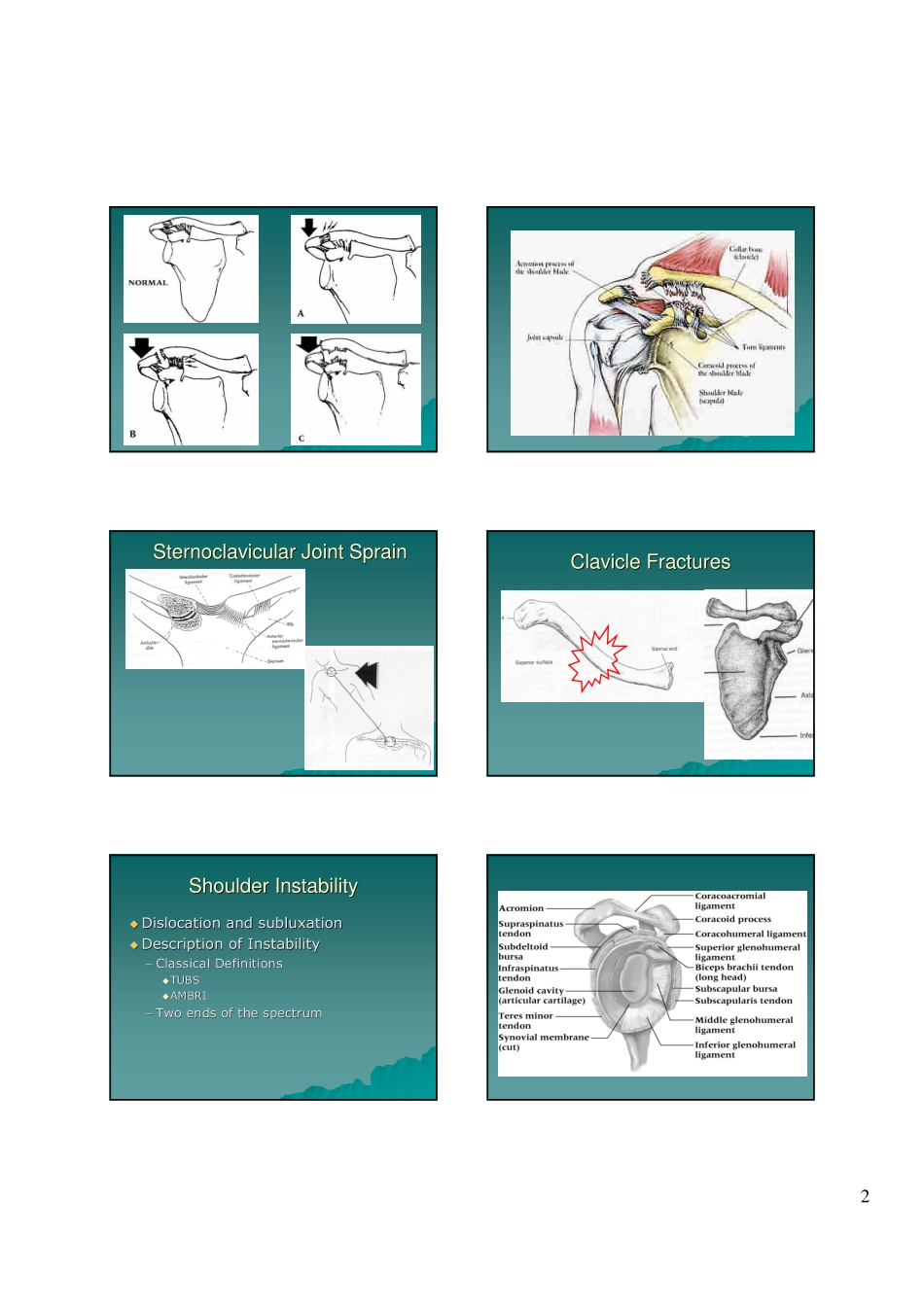 肩峰锁骨关节脱位_第2页