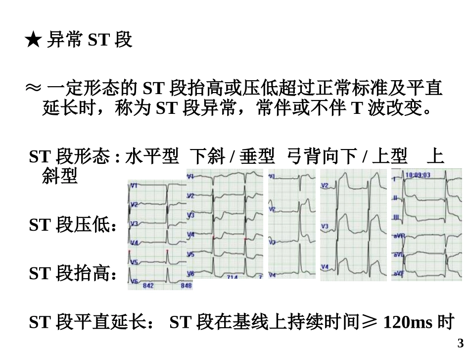 缺血性胸痛时的动态心电图表现_徐金义_第3页