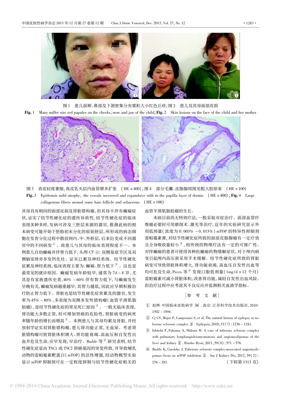 结节性硬化症多系统损害1例_寇晓丽_第2页