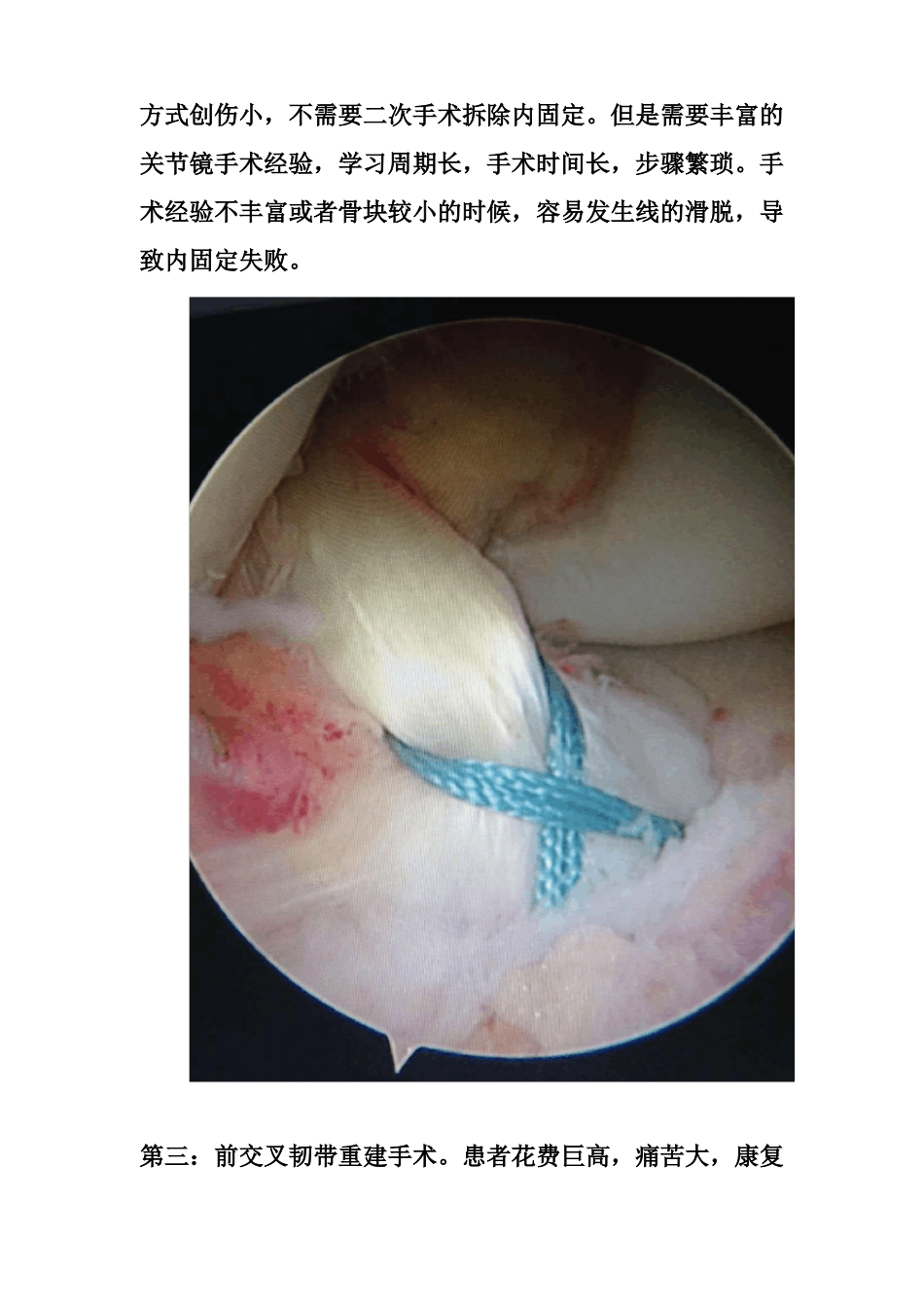 胫骨髁间脊骨折_第2页